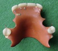 Zahnprothese (1)
