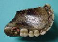 Zahnprothese (3)